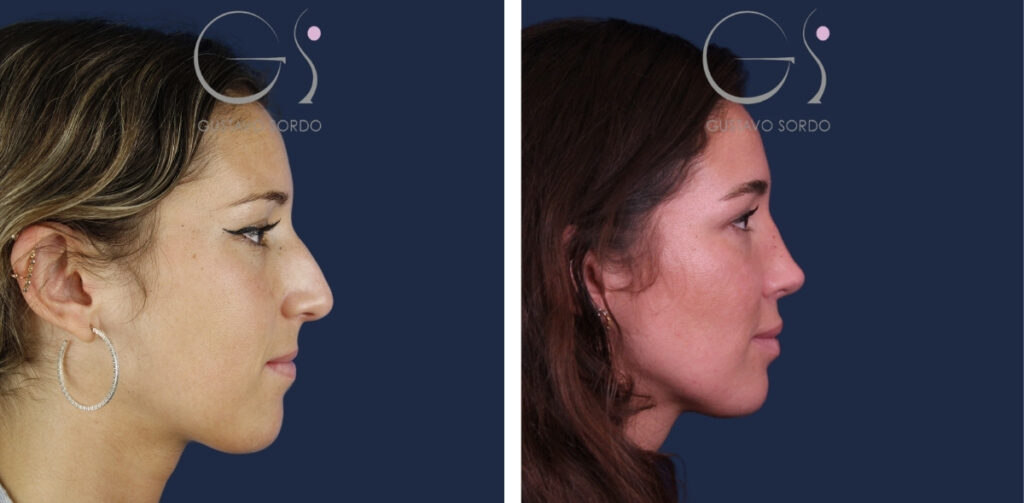 Rhinoplastie — nez aquilin&nbsp;: avant et après une intervention réalisée à Madrid