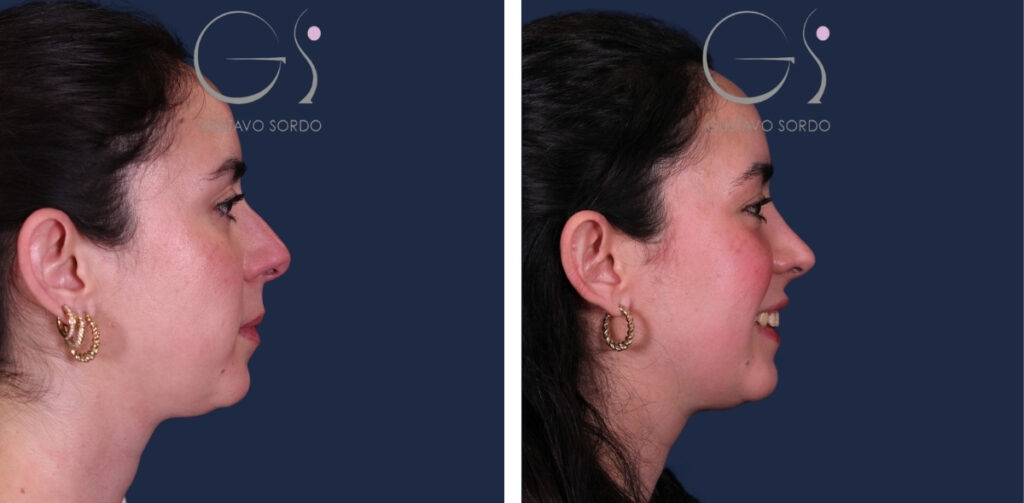 Rhinoplastie — nez droit, résultat naturel&nbsp;: avant et après une intervention réalisée à Madrid