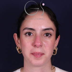 Rinoplastia recta natural, antes de la cirugía — caso operado por el Dr. Gustavo Sordo en Madrid (1)