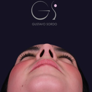 Rinoplastia recta natural, resultado tras la cirugía — caso operado por el Dr. Gustavo Sordo en Madrid (4)