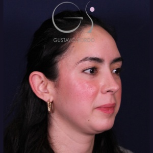 Rinoplastia recta natural, resultado tras la cirugía — caso operado por el Dr. Gustavo Sordo en Madrid (6)