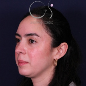 Rinoplastia recta natural, resultado tras la cirugía — caso operado por el Dr. Gustavo Sordo en Madrid (5)