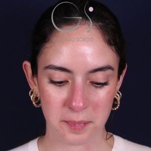 Rinoplastia recta natural, antes de la cirugía — caso operado por el Dr. Gustavo Sordo en Madrid (2)