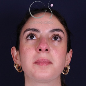 Rinoplastia recta natural, antes de la cirugía — caso operado por el Dr. Gustavo Sordo en Madrid (3)