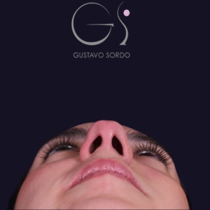 Rinoplastia recta natural, antes de la cirugía — caso operado por el Dr. Gustavo Sordo en Madrid (4)