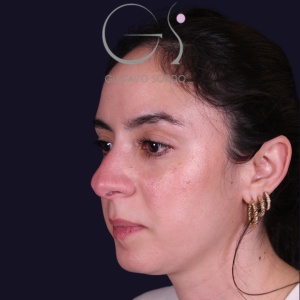 Rinoplastia recta natural, antes de la cirugía — caso operado por el Dr. Gustavo Sordo en Madrid (5)