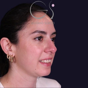 Rinoplastia recta natural, antes de la cirugía — caso operado por el Dr. Gustavo Sordo en Madrid (6)