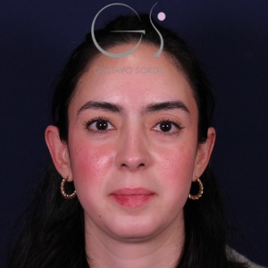 Rinoplastia recta natural, resultado tras la cirugía — caso operado por el Dr. Gustavo Sordo en Madrid (1)