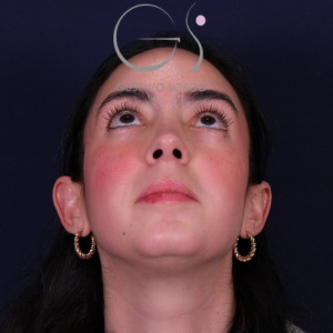 Rinoplastia recta natural, resultado tras la cirugía — caso operado por el Dr. Gustavo Sordo en Madrid (3)