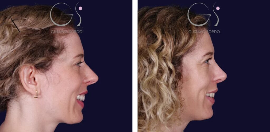 Rinoplastia: antes y después de un caso operado en Madrid