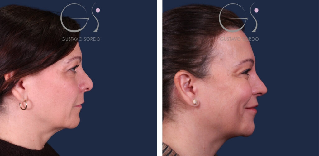 Rinoplastia — nariz bulbosa: antes y después de un caso operado en Madrid