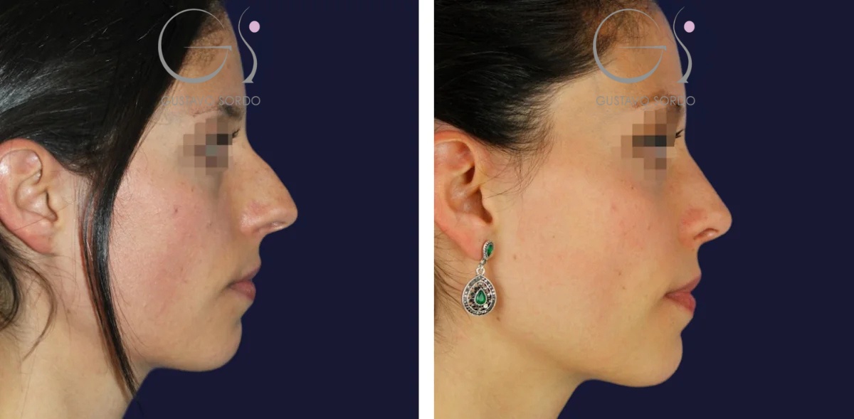Rinoplastia: antes y después de un caso operado por el Dr. Gustavo Sordo en Madrid