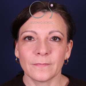Rinoplastia y bulbosa, antes de la cirugía — caso operado por el Dr. Gustavo Sordo en Madrid (1)