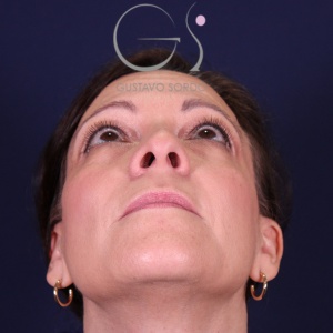 Rinoplastia y bulbosa, antes de la cirugía — caso operado por el Dr. Gustavo Sordo en Madrid (2)