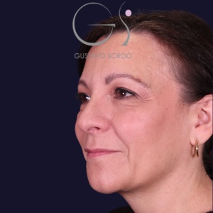 Rinoplastia y bulbosa, antes de la cirugía — caso operado por el Dr. Gustavo Sordo en Madrid (3)
