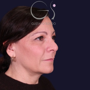 Rinoplastia y bulbosa, antes de la cirugía — caso operado por el Dr. Gustavo Sordo en Madrid (4)