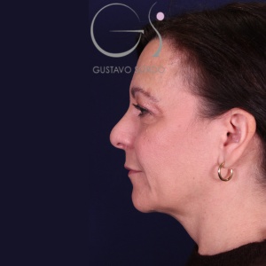 Rinoplastia y bulbosa, antes de la cirugía — caso operado por el Dr. Gustavo Sordo en Madrid (6)