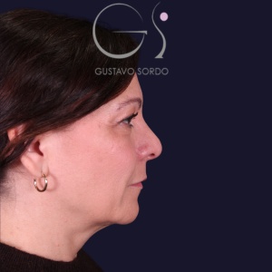 Rinoplastia y bulbosa, antes de la cirugía — caso operado por el Dr. Gustavo Sordo en Madrid (5)