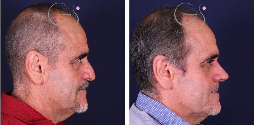 Rinoplastia en hombre antes y después — Dr. Gustavo Sordo