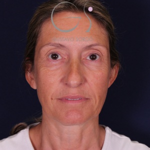 Rinoplastia larga, antes de la cirugía — caso operado por el Dr. Gustavo Sordo en Madrid (1)