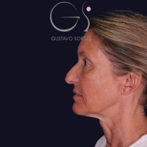 Rinoplastia larga, antes de la cirugía — caso operado por el Dr. Gustavo Sordo en Madrid (4)