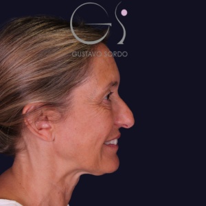Rinoplastia larga, antes de la cirugía — caso operado por el Dr. Gustavo Sordo en Madrid (3)