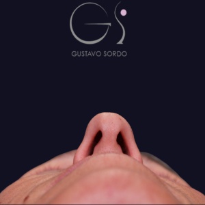Rinoplastia larga, antes de la cirugía — caso operado por el Dr. Gustavo Sordo en Madrid (5)