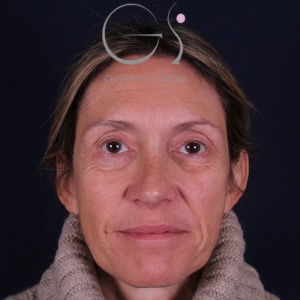 Rinoplastia larga, resultado tras la cirugía — caso operado por el Dr. Gustavo Sordo en Madrid (1)