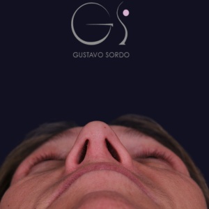 Rinoplastia larga, resultado tras la cirugía — caso operado por el Dr. Gustavo Sordo en Madrid (5)