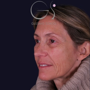 Rinoplastia larga, resultado tras la cirugía — caso operado por el Dr. Gustavo Sordo en Madrid (7)
