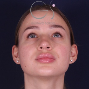 Rinoplastia recta natural, antes de la cirugía — caso operado por el Dr. Gustavo Sordo en Madrid (3)