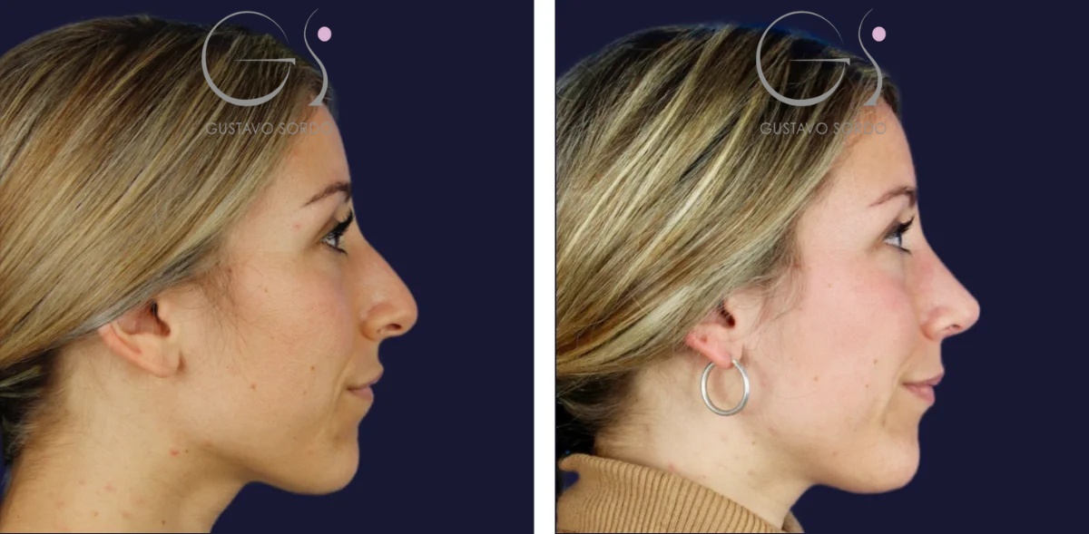 Rinoplastia: antes y después de un caso operado por el Dr. Gustavo Sordo en Madrid