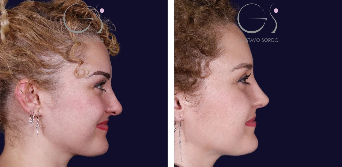 Rinoplastia en nariz ancha con piel gruesa y punta bulbosa: antes y después