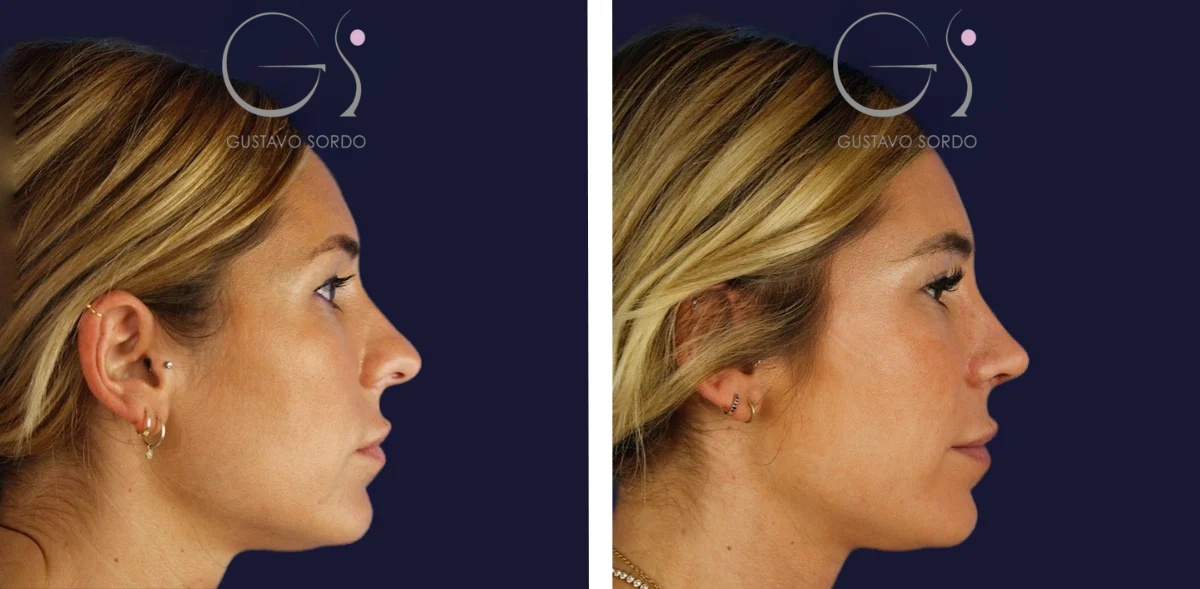 Rinoplastia: antes y después de un caso operado por el Dr. Gustavo Sordo en Madrid