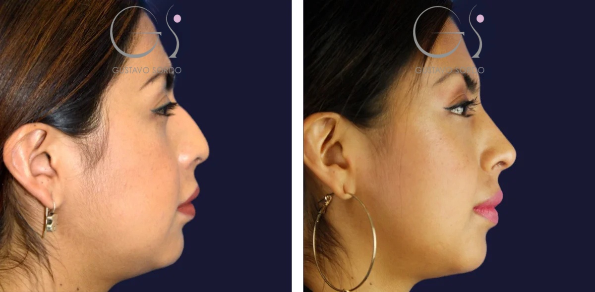 Rinoplastia: antes y después de un caso operado por el Dr. Gustavo Sordo en Madrid