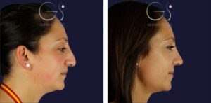 Rinoplastia — técnica ultrasónica: antes y después de un caso operado en Madrid