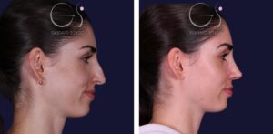 Rinoplastia — nariz recta, resultado natural: antes y después de un caso operado en Madrid