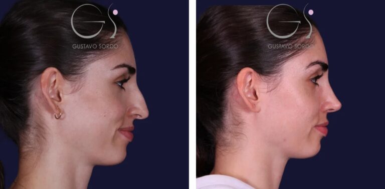 Rinoplastia — nariz recta, resultado natural: antes y después de un caso operado en Madrid