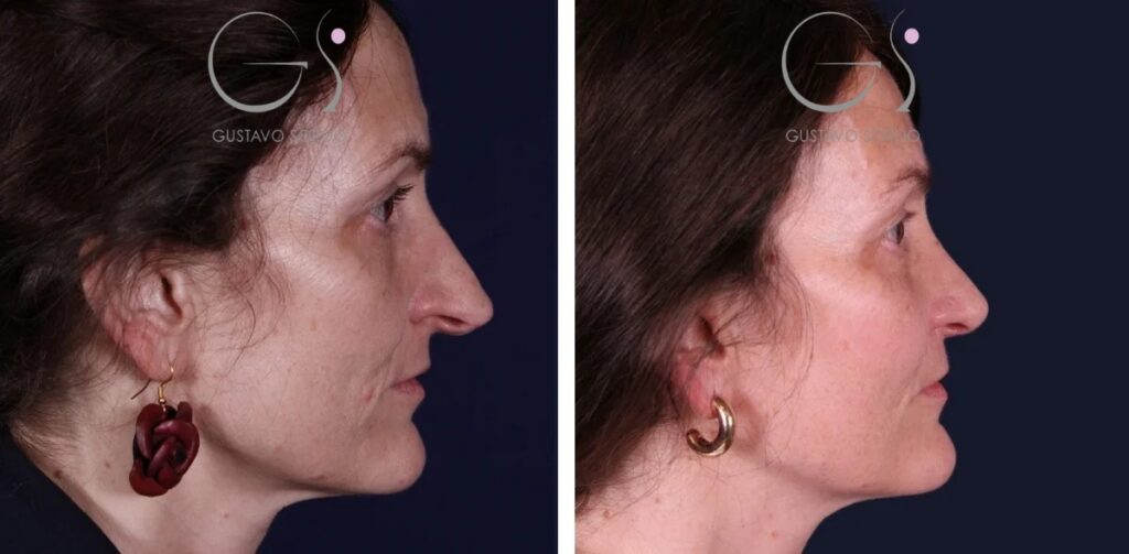 Rhinoplastie — nez aquilin&nbsp;: avant et après une intervention réalisée à Madrid