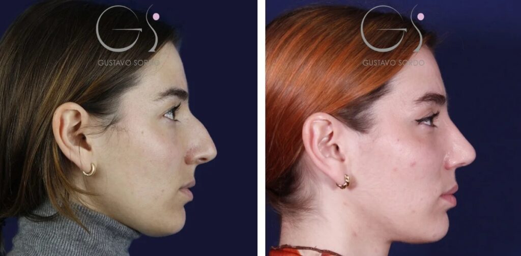 Rhinoplastie — nez aquilin&nbsp;: avant et après une intervention réalisée à Madrid