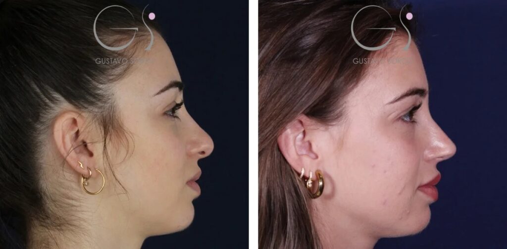 Rinoplastia — nariz bulbosa: antes y después de un caso operado en Madrid