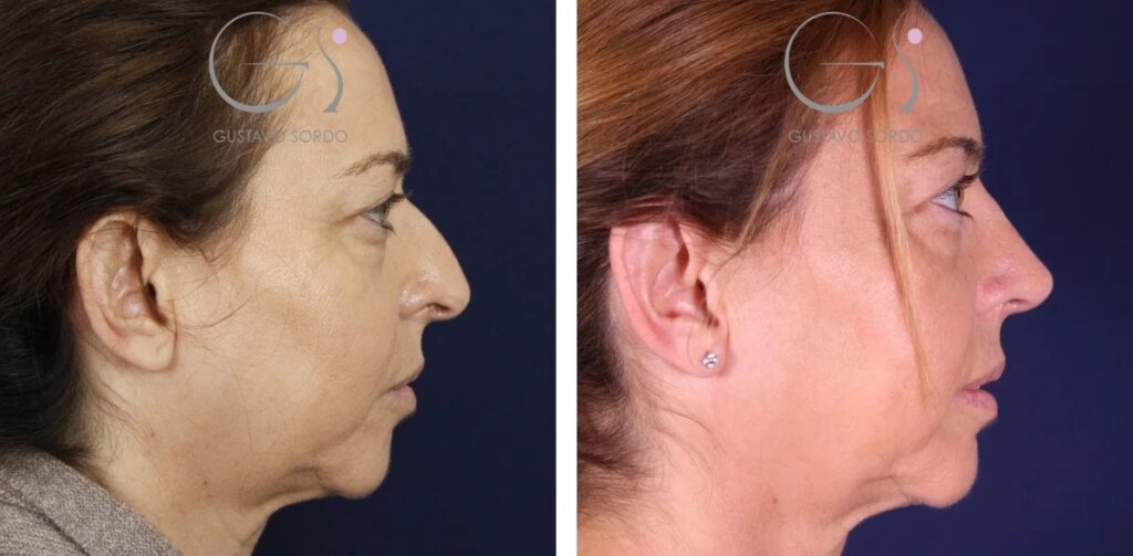Rhinoplastie – pointe tombante&nbsp;: avant et après une intervention réalisée à Madrid