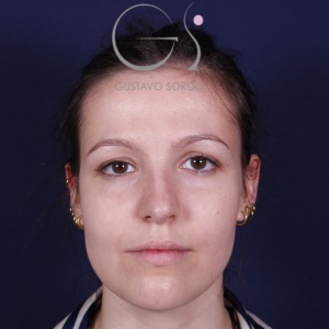 Rinoplastia recta natural, antes de la cirugía — caso operado por el Dr. Gustavo Sordo en Madrid (1)