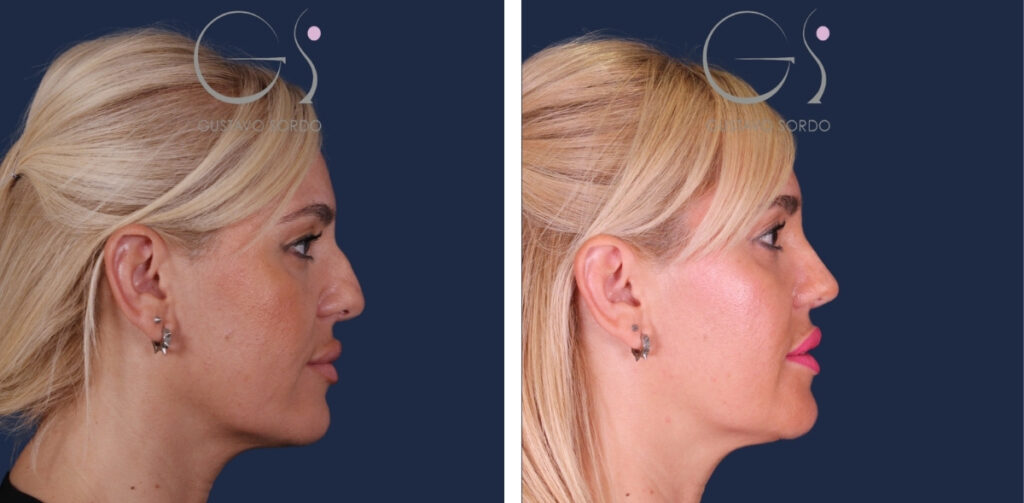 Rhinoplastie — nez droit, résultat naturel&nbsp;: avant et après une intervention réalisée à Madrid