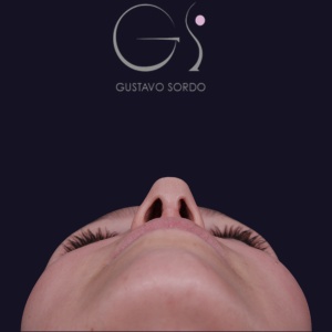 Rinoplastia recta natural, resultado tras la cirugía — caso operado por el Dr. Gustavo Sordo en Madrid (4)