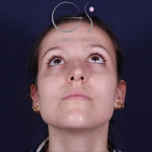 Rinoplastia recta natural, antes de la cirugía — caso operado por el Dr. Gustavo Sordo en Madrid (3)