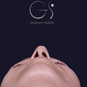 Rinoplastia recta natural, antes de la cirugía — caso operado por el Dr. Gustavo Sordo en Madrid (4)