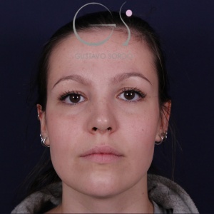 Rinoplastia recta natural, resultado tras la cirugía — caso operado por el Dr. Gustavo Sordo en Madrid (1)
