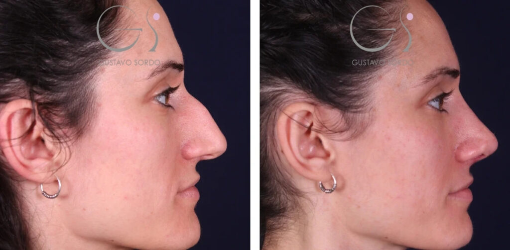 Rhinoplastie : avant et après une intervention réalisée à Madrid