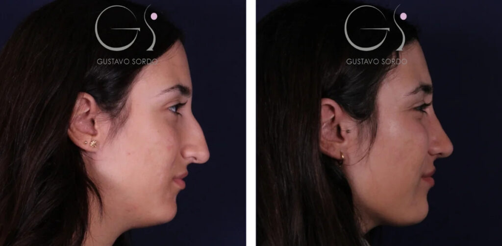 Rhinoplastie : avant et après une intervention réalisée à Madrid